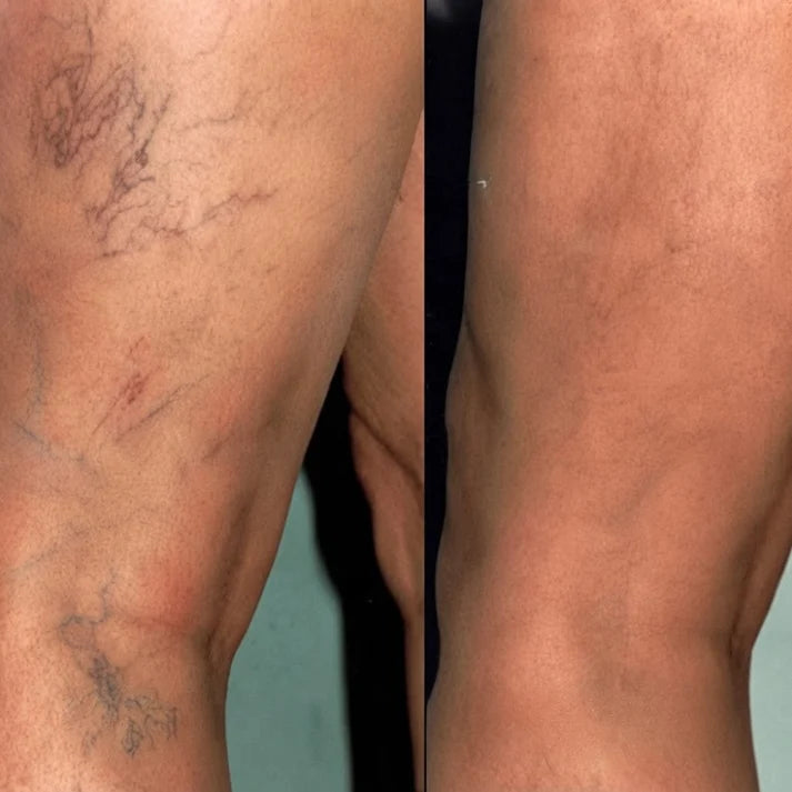 VenoEase™ | Reduce the appearance of varicose veins by up to 98% in 5 days and show your legs with pride again